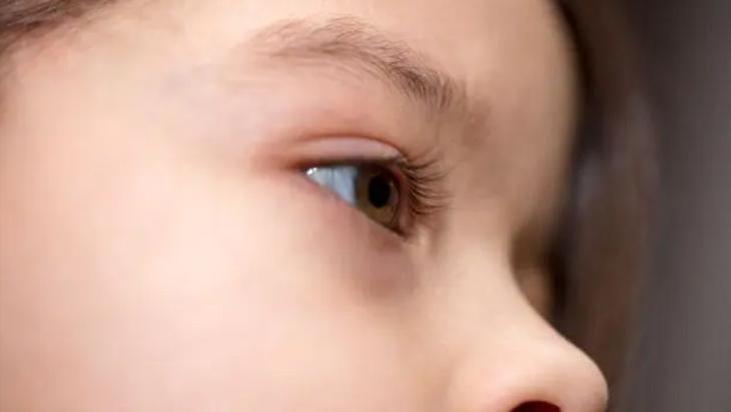 Çocuğunuzun göz altlarında koyu halkalar mı var? Mantıklı bir açıklaması olabilir