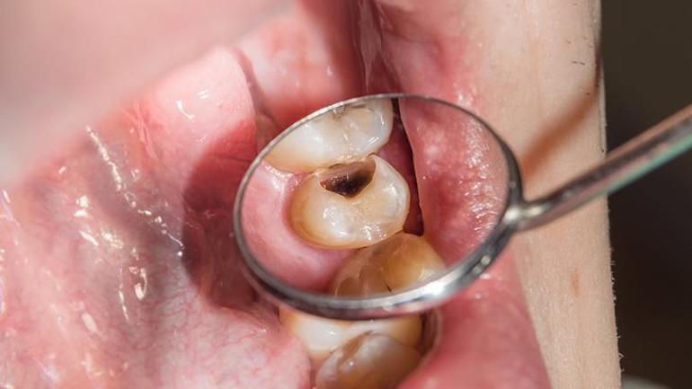 Dikkate alınmazsa diş kaybına yol açabilen 4 yaygın neden