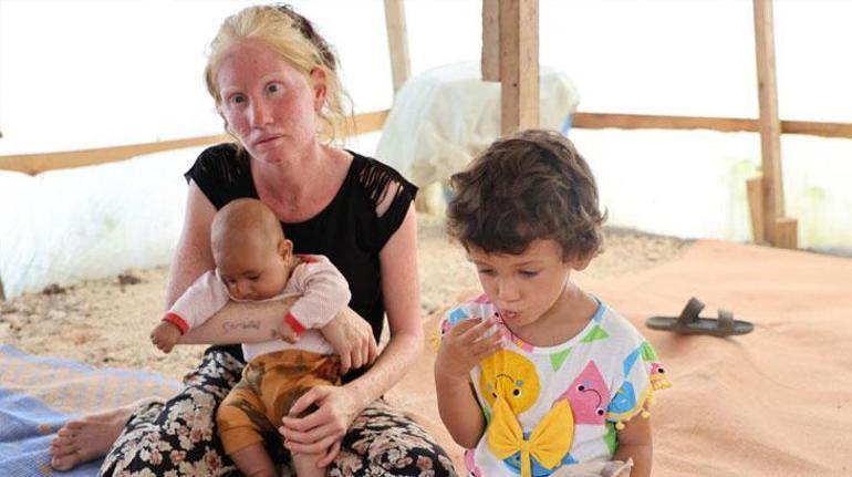 Albino kadın Adana sıcağında 3 çocuğuyla çadırda yaşadıklarını anlattı